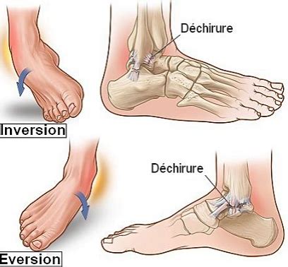 Entorse De La Cheville Causes Signes Et Traitements