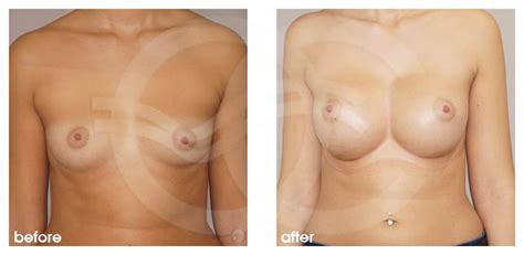 Augmentation Mammaire Avant Apr S Grossir Seins Implants Cc Marbella