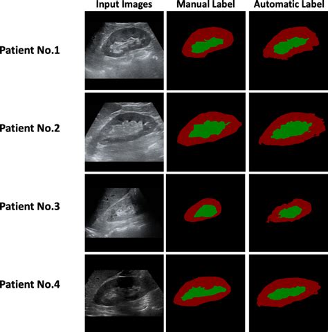 Manual And Automatic Segmentation Using Ultrasound Images Of The