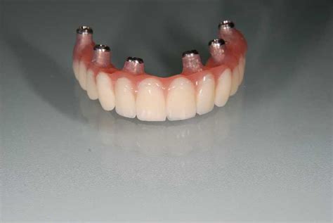 Full Arch Implant Bridges Demajo Dental