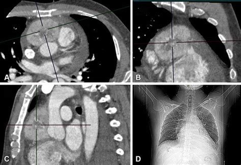 Mediastinal Mass An Unusual Location For A Paraganglioma Radiology