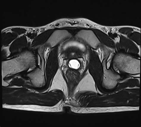 Mullerian Cyst Female