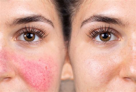 How To Get Rid Of My Rosacea The Well By Northwell