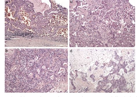 Figure 3 From Synchronous Multiple Unilateral Parotid Gland Tumors Of