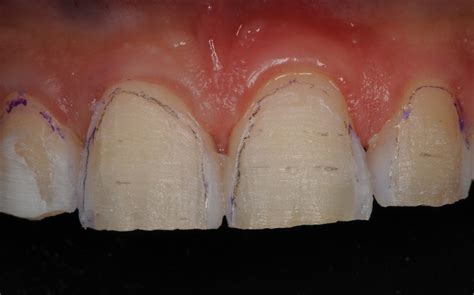 Veneer workflow and temporary restoration management