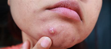 Acne Vs Face Rash A Diy Projects