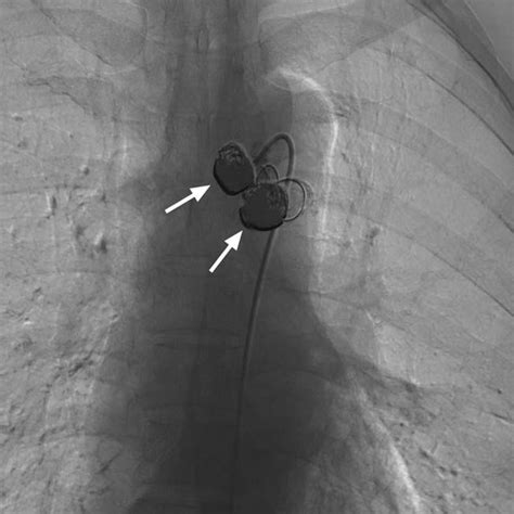 Arteriography After The Embolization Of Vascular Bed And Aneurysms