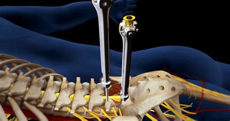 L5-S1 Herniated Disc Surgery - Discseel