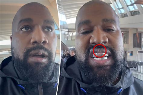 Fans Question Protruding Growth On Kanye Wests Lip After Dental Implant