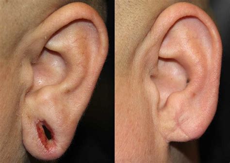 Otoplasty Earlobe Repair