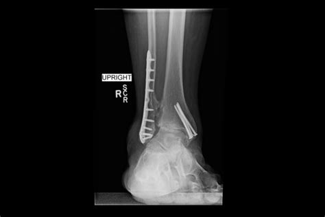 Ortho Dx Ankle Pain For Months Clinical Advisor