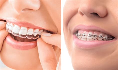 Invisalign Vs Braces Choosing The Right Smile Solution