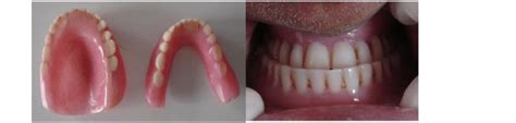 Patients Worn Out Old Dentures Deviation Towards Right Side When