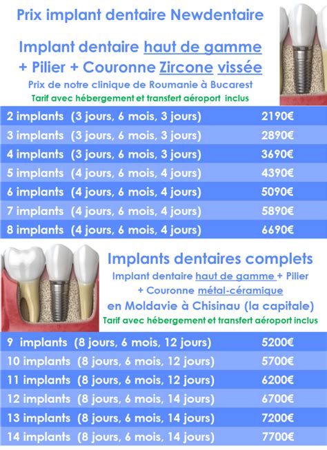 Prix Implant Dentaire Tout Ce Qu Il Faut Savoir Sur Le Prix Des Implants