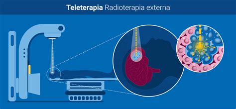 Qu Es La Radioterapia Oiea