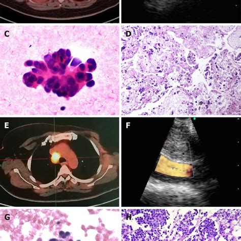 Endobronchial Ultrasound Guided Transbronchial Needle Aspiration For