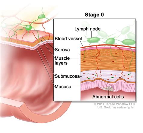 Stage 0 Colonrectal Carcinoma In Situ Shows A Cross Section Of The
