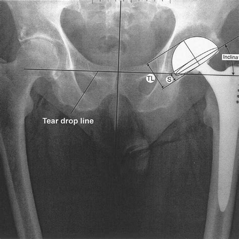 Radiographic Cup Anteversion As Determined By This Method And By