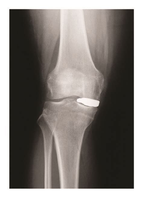 Patient Specific Interpositional Knee Device Conformis Iforma Pre