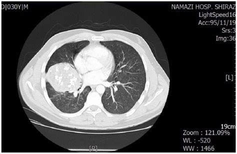 Giant Hamartoma Of Lung Presented With Massive Hemoptysis A Rare Case