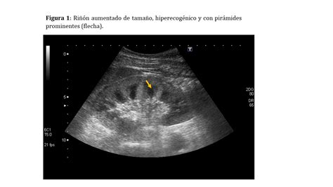 Ecografía en la Enfermedad Renal Nefrología al día