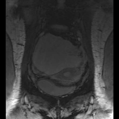 Ovarian Torsion