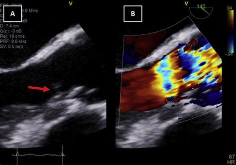 Subaortic Stenosis What Lies Beneath Case