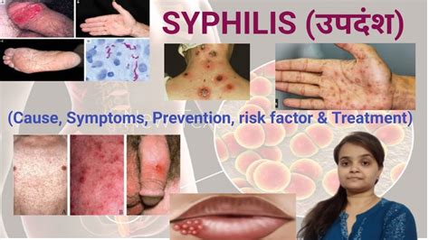 Syphilis उपदंश Cause Symptoms Stages Risk Factor Prevention