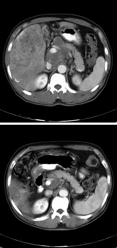 Abdominopelvic Ct Scans Of Patient No Which Shows Multiple