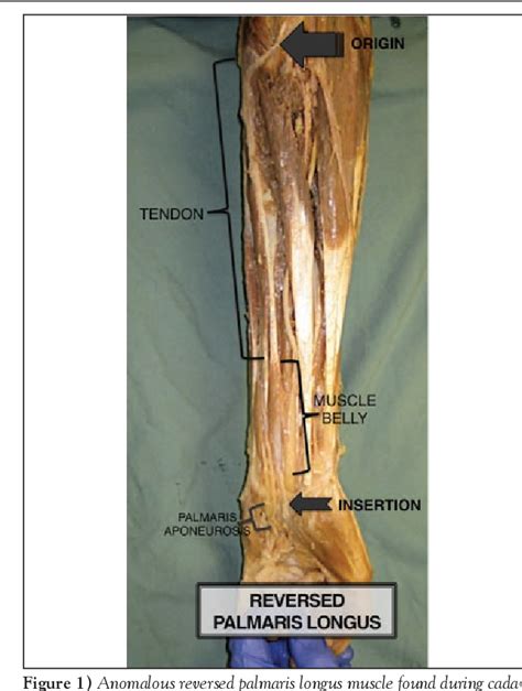 Palmaris Longus Origin And Insertion