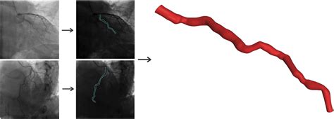 dimensional reconstruction   coronary artery