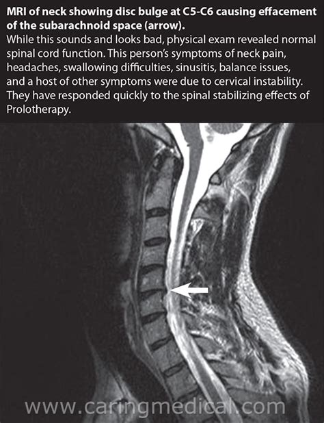 Cervical Disc Disease And Difficulty Swallowing Cervicogenic Dysphagia