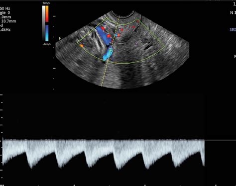 Transvaginal Pulsed Wave Doppler Image Showing An Umbilical Arterial