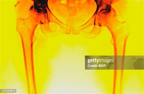 69 Arthritis Of The Hip X Ray Stock Photos, High-Res Pictures, and ...