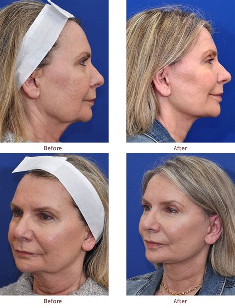 Mini Facelift Before And After