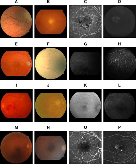 Quality Assessment Of Colour Fundus And Fluorescein Angiography Images