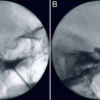 Fluoroscopy Guided Percutaneous Balloon Compression In Lateral View A