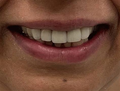 Case 30 Smile Makeover Smile 360 Dental Dentists In Harrow Greater London