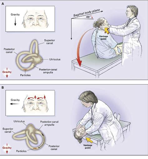 Figure 1 From Management Of Benign Paroxysmal Positional Vertigo With