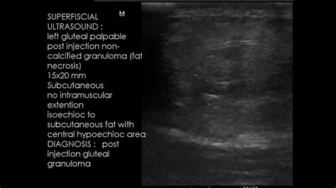 Case 954 Post Injection Gluteal Granuloma Youtube