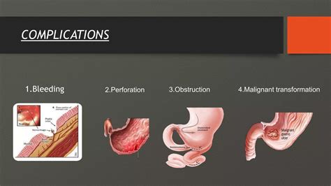 Gross And Histopathological Findings And Complications Of Gastric Ulcers Ppt