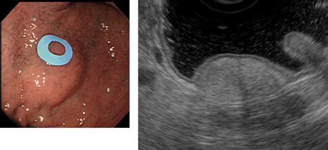 Endoscopic Ultrasonography Diagnosis Of Subepithelial Lesions Kida