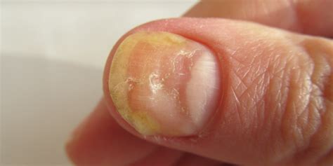 What Is A Damaged Nail Bed At Scott Crouse Blog