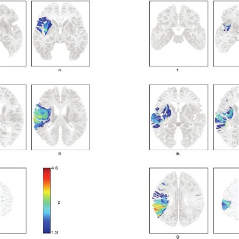 Voxel Based Lesion Symptom Mapping Vlsm Maps Showing P Values Of All