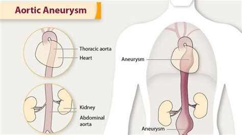 Aneurysm Types Symptoms And Causes Page 2 Entirely Health