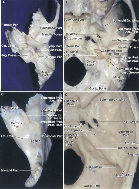 Temporal Bone And Transtemporal Approaches The Neurosurgical Atlas