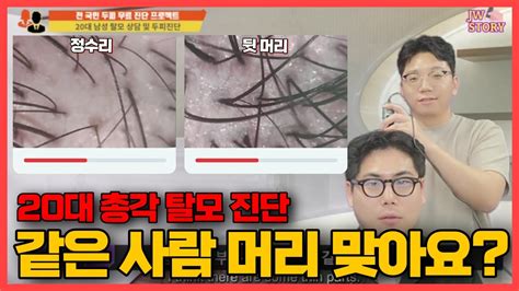 고객님 두피진단 Case5 20대 남성 탈모 유전성 탈모 Men In Their 20s Have Hair Loss