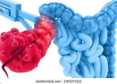 65 Laparoscopic Appendectomy Images Stock Photos Vectors Shutterstock