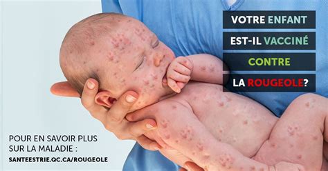 Campagne De Vaccination Contre La Rougeole Ciusss De L Estrie Chus