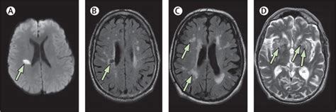 Mechanisms Of Sporadic Cerebral Small Vessel Disease Insights From